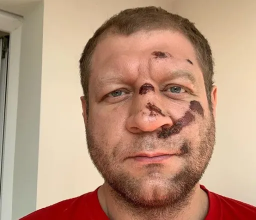 Александр Емельяненко пропустит бой из-за падения с велосипеда